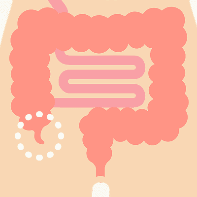 盲腸のイラスト